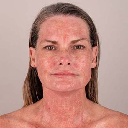 Woman's face immediately following an RF microneedling treatment