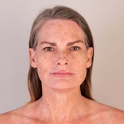 Woman's face before a RF microneedling treatment shows sun damage and brown spots