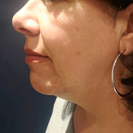 Side profile image of a woman's face 3 months after receiving RF Microneedling.