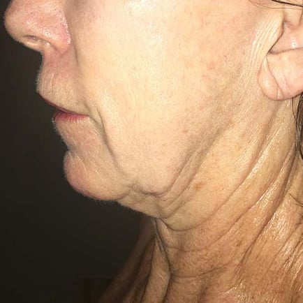 Woman's face and neckline before RF Microneedling treatment