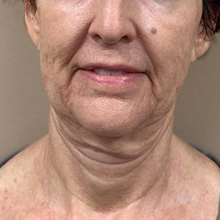 Front facing image of a woman before RF Microneedling treatment
