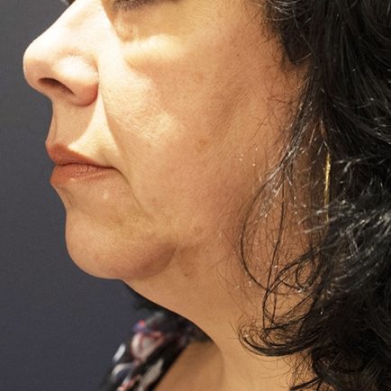 Profile image of woman's face before Microneedling with Radiofrequency treatment.