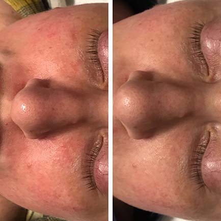 Woman's nose and cheeks with improved appearance of redness and rosacea before and after IPL photo rejuvenation treatments.