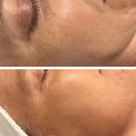 Reduction in brown age spots on a woman's cheeks after Lumecca IPL photo rejuvenation