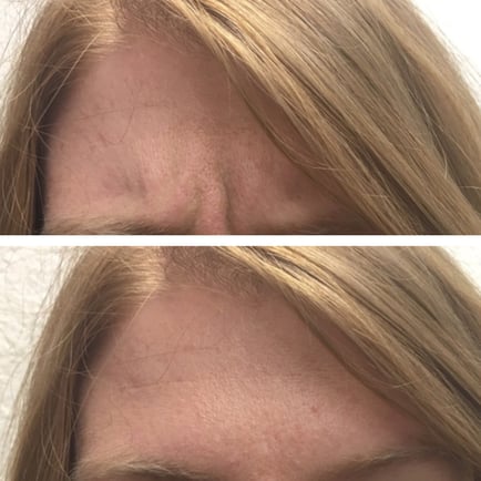 Before and after composite of woman's forehead before and after Dysport injections, showing the reduction of vertical lines between her eyes.