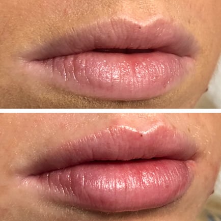 Plumper, more defined woman's lips after receiving Juvederm lip filler.