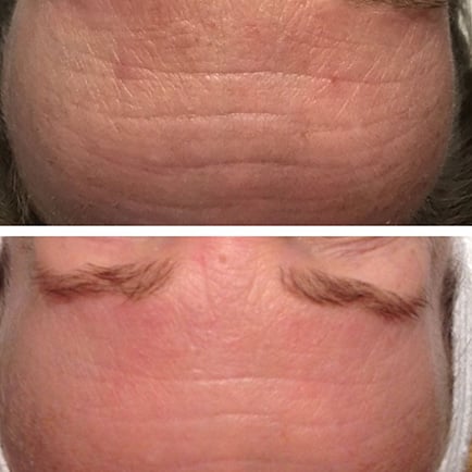 Minimized appearance of deep lines on a man's forehead in microneedling before and after.