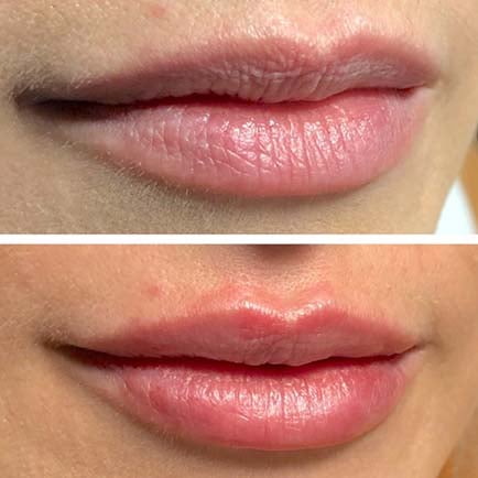 Hyaluronic Acid for Lip Injections: Benefits, Site Effects, Costs