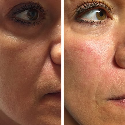 Woman's cheeks before and after Juvderm Voluma cheek filler, showing added volume and contour.