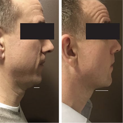 Before and after image of a man with reduced double chin and improved profile after Kybella treatments.