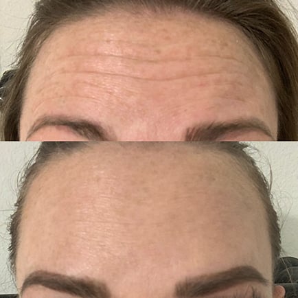 Woman's forehead lines before and after Dysport injections.