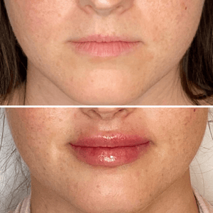 Before and after photo of Restylane Kysse lip filler treatment