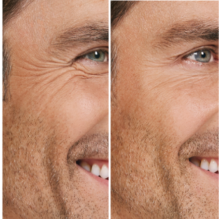 Botox Before/After Photo Treatment of Male Crow's Feet