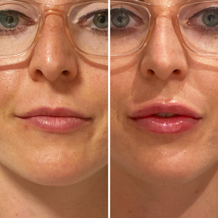 Juvederm lip filler before and after close-up at Viva Day Spa + Med Spa