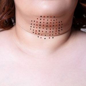 Woman's double chin with markings for Kybella treatment to dissolve it.
