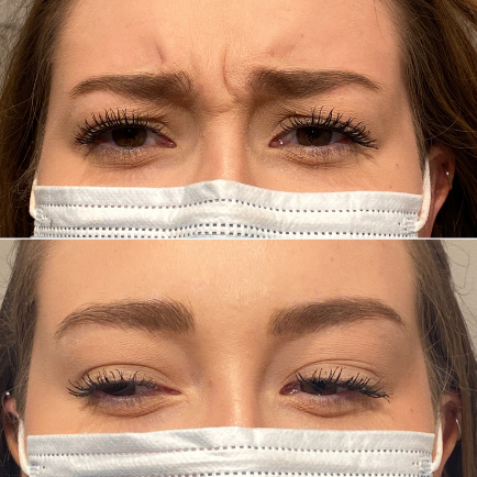 Before And After of Botox in Glabular Area, also known as 