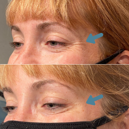Before and After Botox treatment for Crow's feet with 20 units, 10 on each side of the eyes