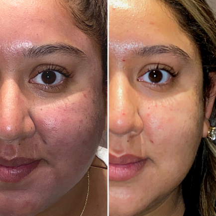 Before and after microneedling by SkinPen of a young, female patient at Viva Day Spa + Med Spa.