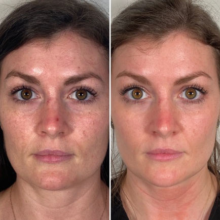 Morpheus RF Microneedling before and after photo of female client