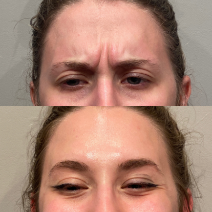 Photo of a young woman's forehead before and after Dysport injections to treat her glabella (elevens).