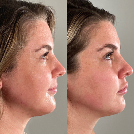 Facial profile of a young woman before and after receiving jawline filler with Juvederm Voluma.