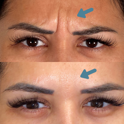Woman's forehead before and after Botox injections for the glabella between the eyes