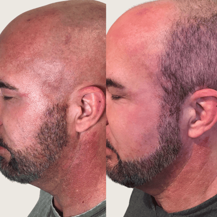 Male Before and After IPL Photofacial for Vascular Lesions on the neck and faceat Viva Day Spa
