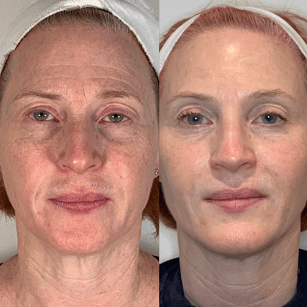 Female patient before and after Morpheus8 RF Microneedling