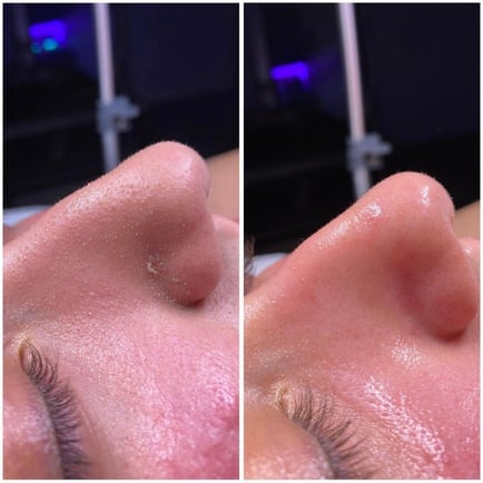 HydraFacial Before and Afer