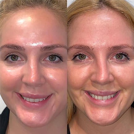 Woman's face before and after tear trough/eye hollow filler at Viva Day Spa + Med Spa in Austin, Texas.