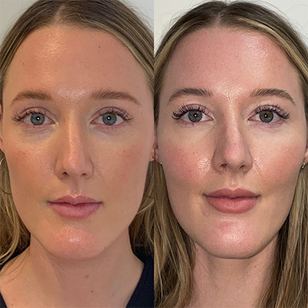 Before and after photo of woman's cheek filler & lip filler treatment at Viva Day Spa + Med Spa in Austin, Texas.