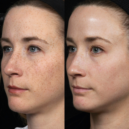Before and after close-up photo of a younger woman's face, showing improved brightness and reduced sun damage after receiving two Fraxal Dual laster treatments.