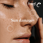 Close-up of a woman's face with brown spots and sun damage before receiving a Fraxel laser resurfacing treatment.