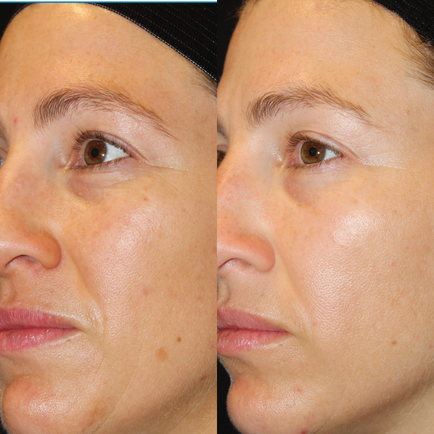Before and after close-up of an woman's face showing improvement to pigmentation and brightness 20 weeks after receiving three Clear + Brilliant laser resurfacing treatments.