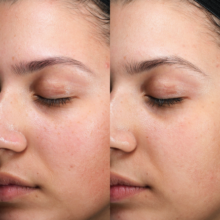 Before and after close-up of a young woman's face showing improvement to pigmentation and a radiant glow 9 weeks after receiving two Clear + Brilliant laser resurfacing treatments.