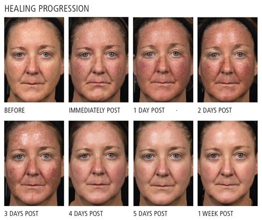 Close-up of a woman's face showing the progression of healing by day for a week after receiving a Fraxel Dual Laser Resurfacing treatment.
