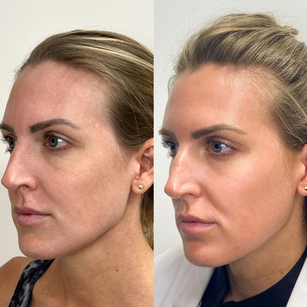 Before and after photo of a female patient's face after one Fraxel Dual laser resurfacing treatment at Viva Day Spa + Med Spa in Austin, Texas.