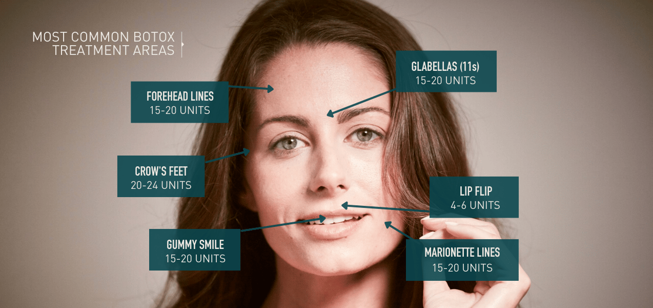 Diagram of the most common Botox treatment areas on a woman's face including forehead lines (15-20 units), glabella or 11s (15-20 units), crow's feet (20-24 units), lip flip (4-6 units), gummy smile (15-20 units) and marionette lines (15-20 units) at Viva Day Spa + Med Spa in Austin, Dallas, and Round Rock, TX
