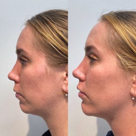 29 year old female patient at Viva Day Spa + Med Spa in Austin, TX received a full face rejuvenation with Kybella for double chin fat (submental), 2 syringes of Volux filler for jawline,1 syringe of Voluma for cheeks, 1 syringe of Vollure filler for lips, and full face Botox injections.