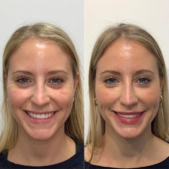 Lip-Filler-Tear-Trough-Filler-Liquid-Rhinoplasty-Austin_276x276