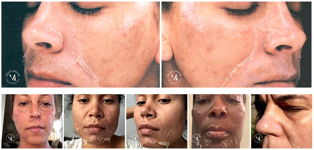 VI Peel Peeling Process